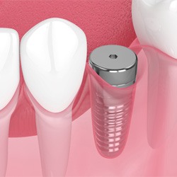 Digital illustration of a dental implant in Denver