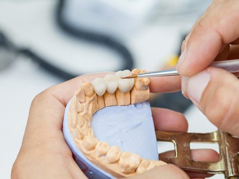Dental bridge is crafted at lab