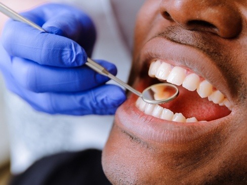 Close up of man getting checkup after tooth colored filling treatment