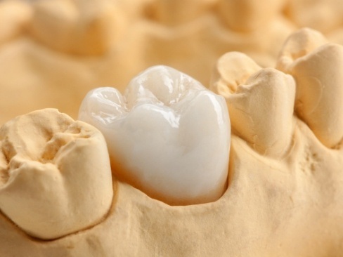 Close up of model smile with dental crown restoration