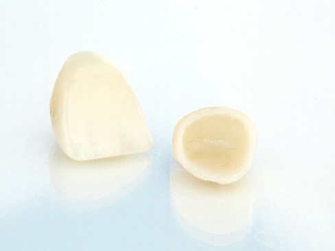 Closeup of a porcelain dental crowns in Denver
