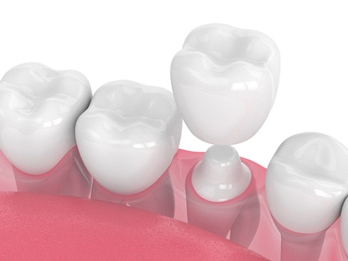 Diagram showing a dental crown in Denver being placed