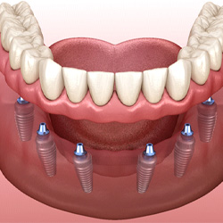 Implant dentures in Denver