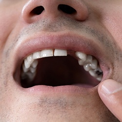 A man pointing out his missing tooth