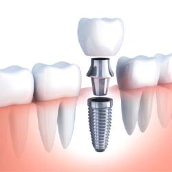 3D illustration of dental implant