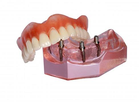 Model of implant dentures