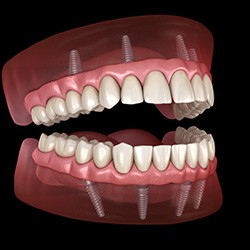 Illustration of fixed implant dentures