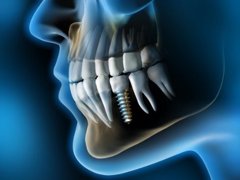 3 D image of a dental implant supported replacement tooth in jaw