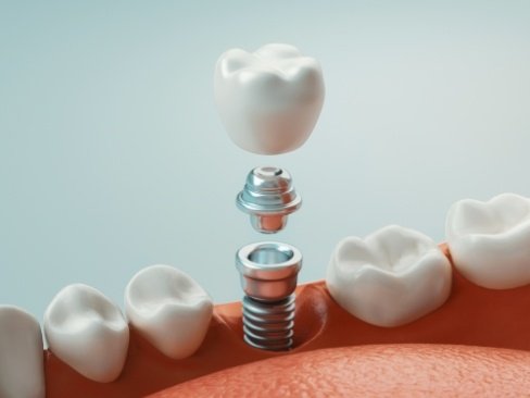 Three parts of a dental implant replacement tooth