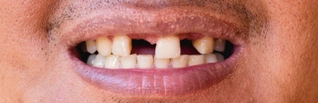 Closeup of smile with multiple missing teeth