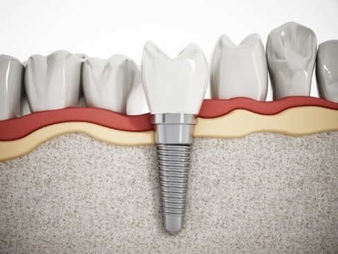 illustration of dental implant