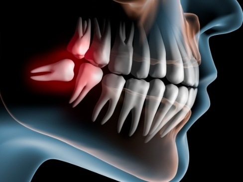 Animated smile showing impacted wisdom tooth